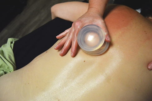 Myofascial cupping performed on client's back.