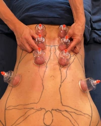 Myofascial cups placed on client's back